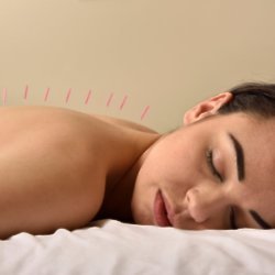 Acupuncture