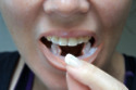 Missing teeth